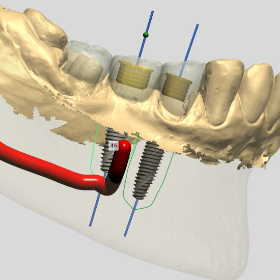 Planejamento virtual do implante dentário realizado pelo radiologista